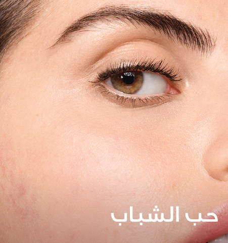 /~vichy/st-STZSNQ-Acne