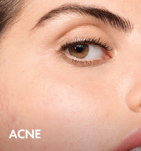 /~vichy/st-STZSNQ-Acne